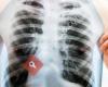 Asociacion enfermos pulmonares- EPOC enfermos y familiares